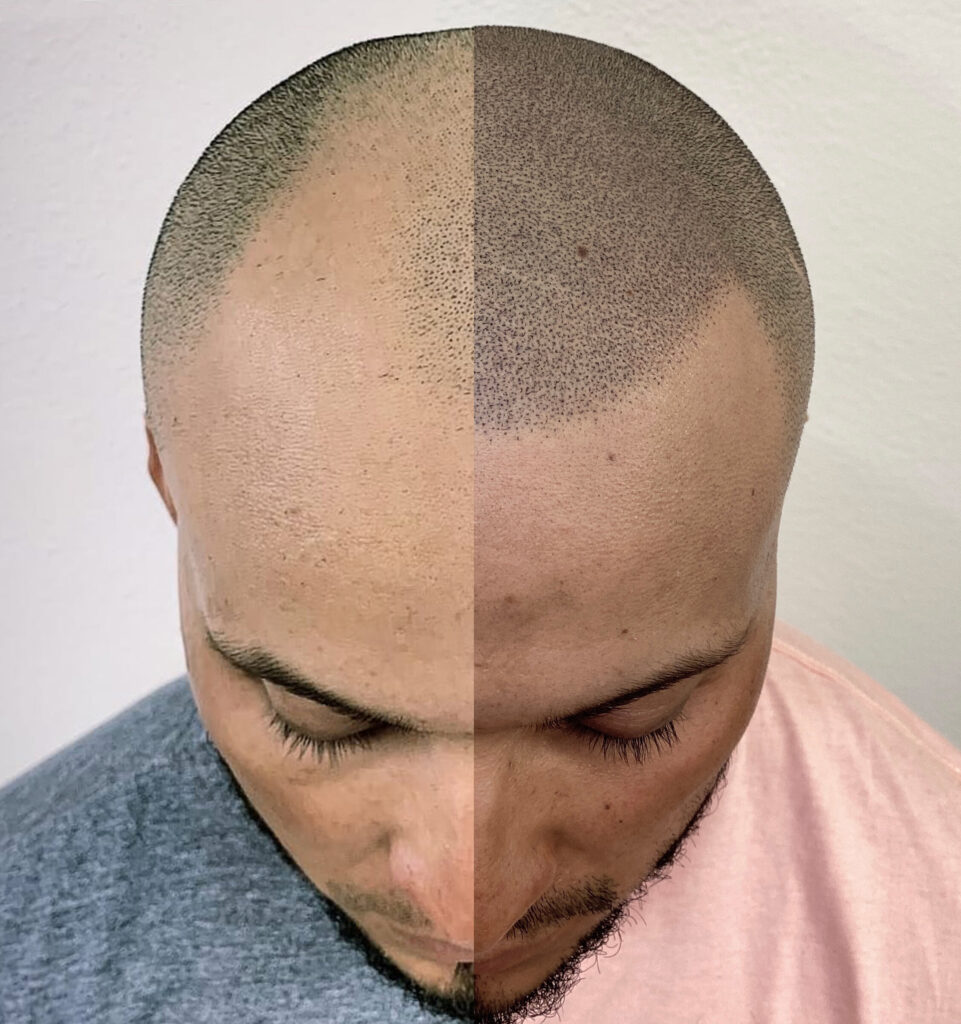 Male Pattern Baldness Treatment l Atlantis Medical