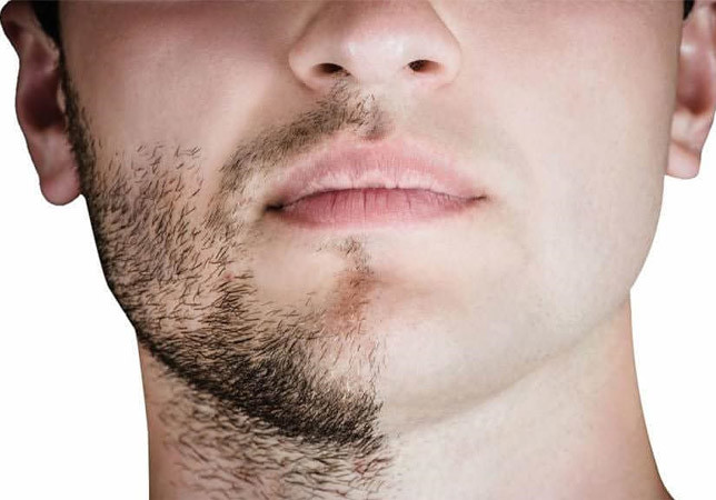 Facial Hair Treatment l Atlantis medical